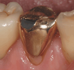 Perforated Crown