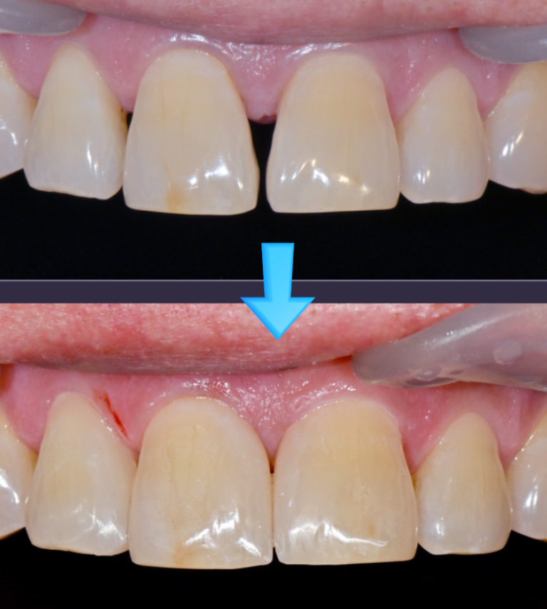 Direct Resin