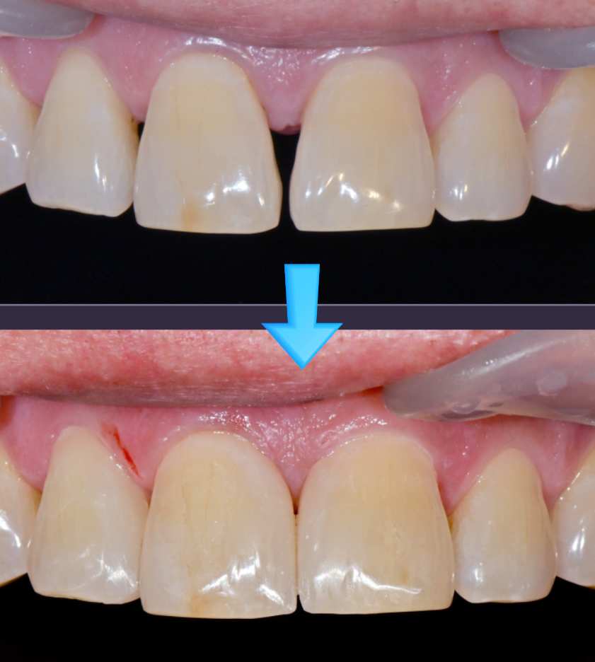 Direct Resin