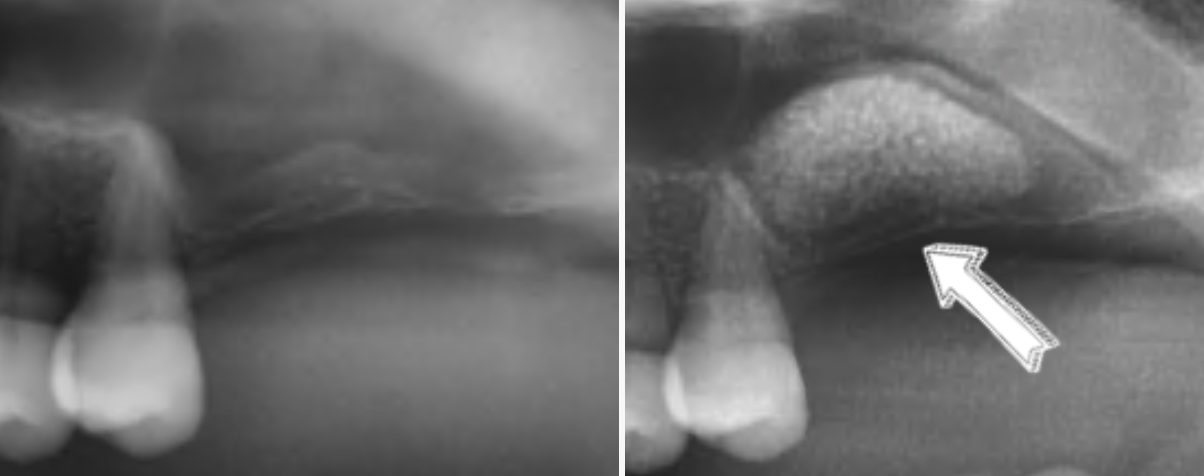 상악동 거상술 전후