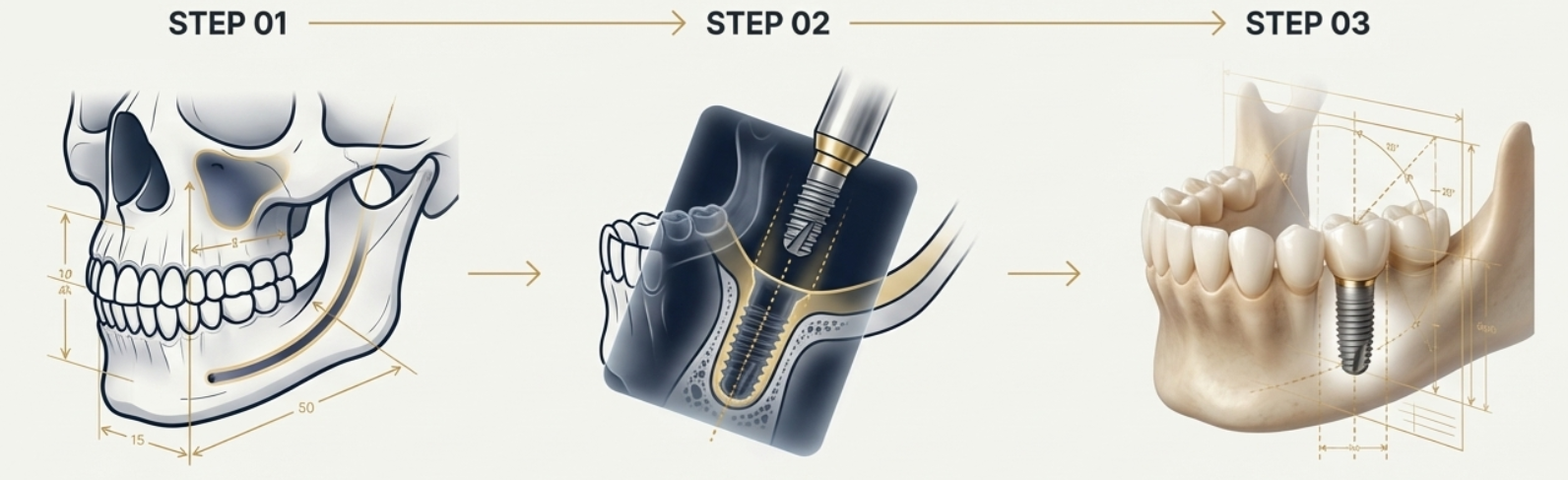 임플란트 식립 수술 과정