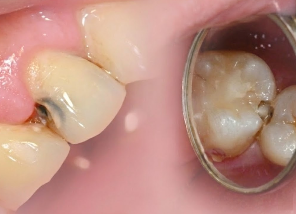 서울프라임치과 DSLR 정밀 진단 사례