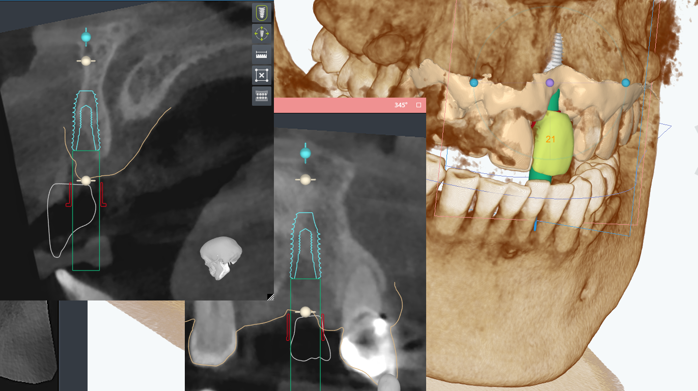 가이드 설계 증례