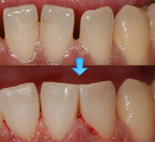 Direct resin